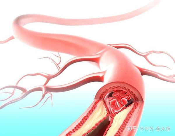 动脉斑块最新治疗方法,探索动脉斑块治疗新突破。