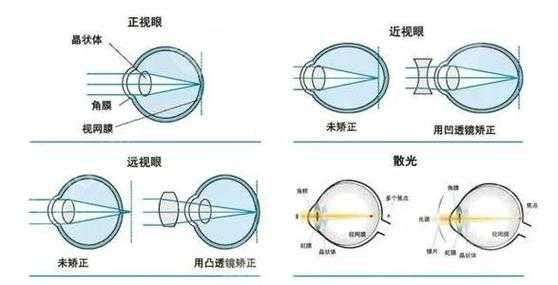 最新近视技术,前沿近视矫正技术