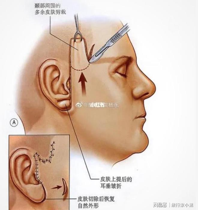 最新小拉皮手术方法,创新小拉皮手术技术解析